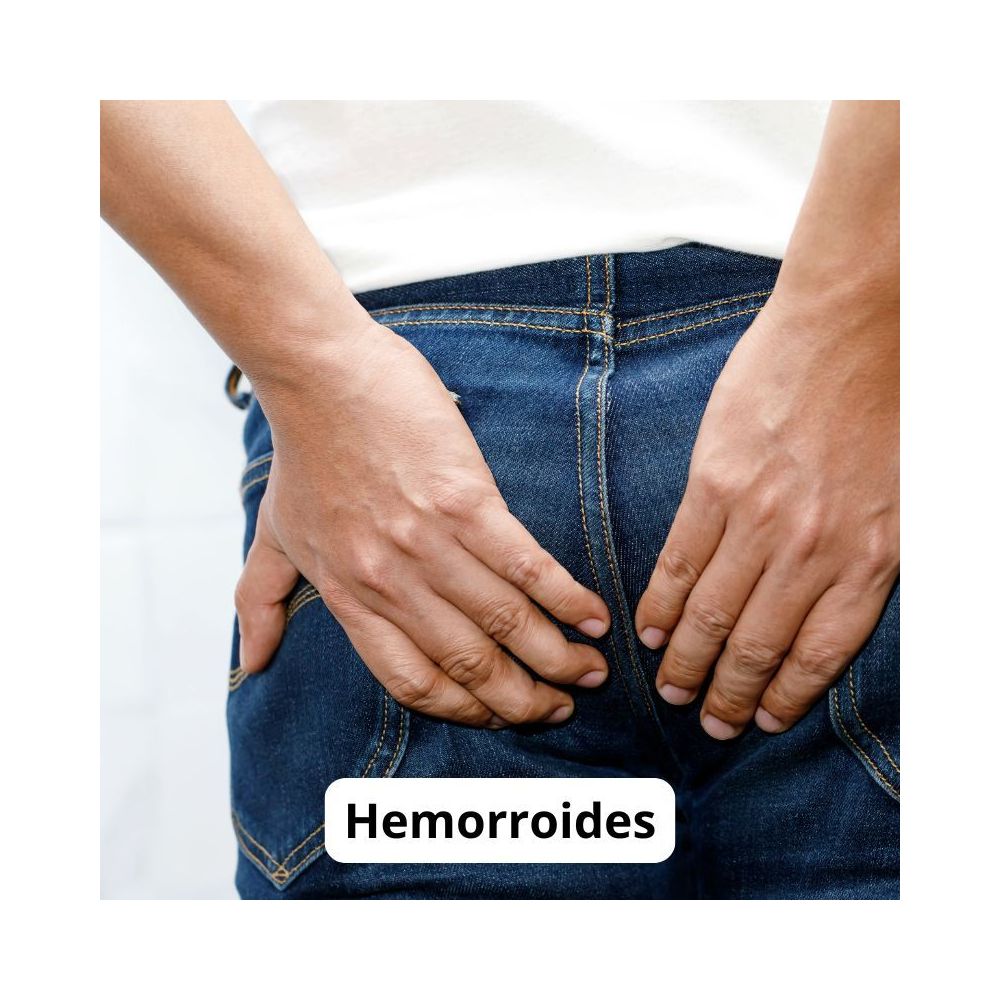 Hemorroides Internas y Externas: Síntomas
