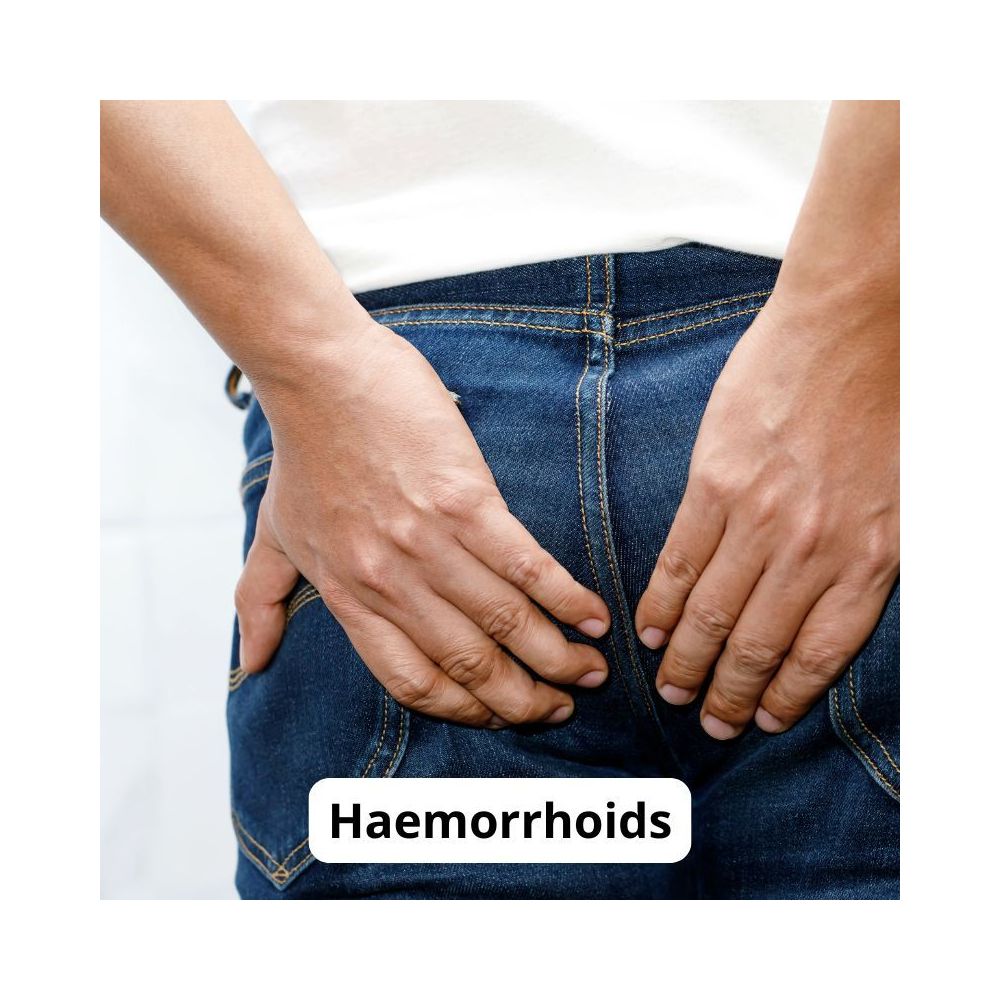 Internal and External Haemorrhoids