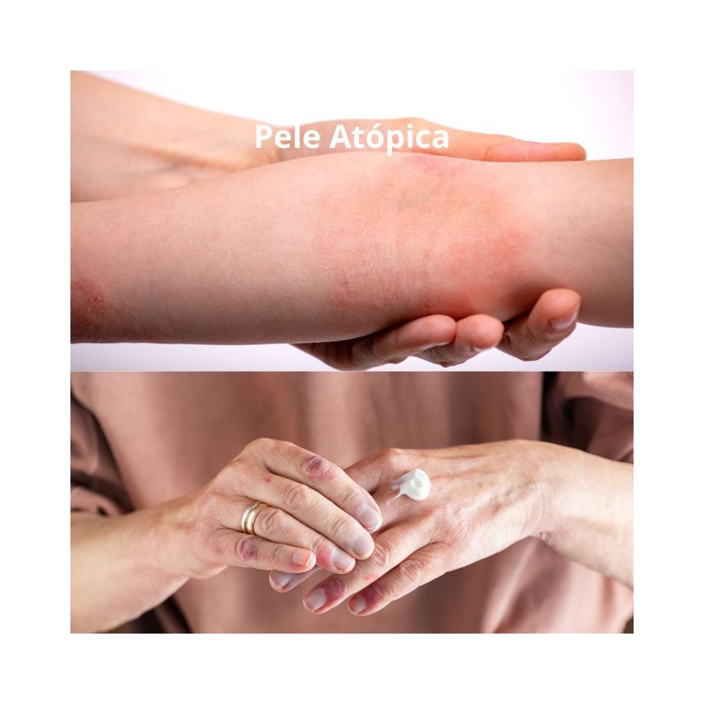 O que é a Pele Atópica?