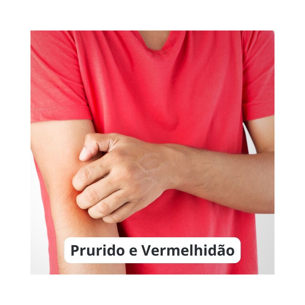 Prurido e Vermelhidão: Como Tratar e Aliviar os Sintomas