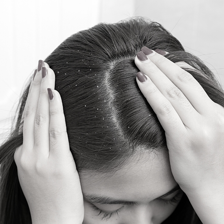 Anti-Dandruff Shampoos